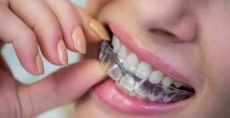 adult putting invisalign on