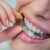 adult putting invisalign on