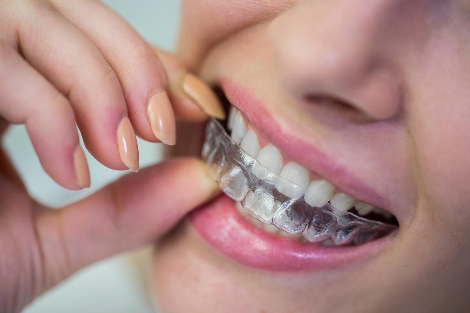adult putting invisalign on