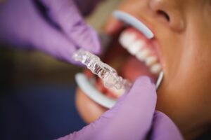 fitting invisalign dentures