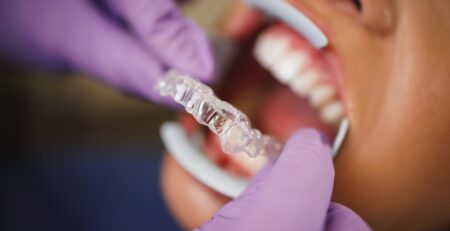 fitting invisalign dentures
