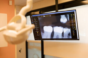 gum disease shown on xray scan