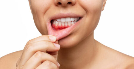 gum inflammation cropped shot young woman shows red bleeding gums pulling lip