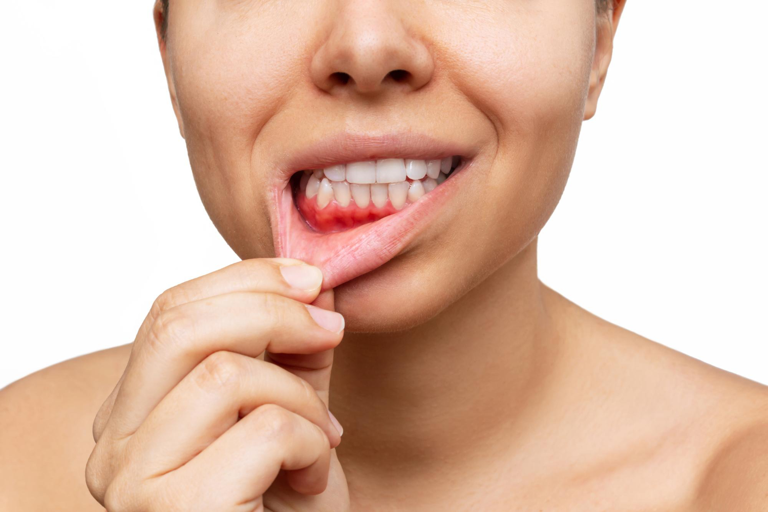 gum inflammation cropped shot young woman shows red bleeding gums pulling lip