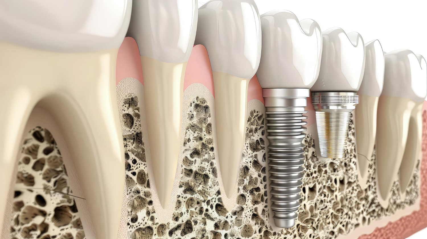 implants