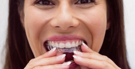 invisalign installation