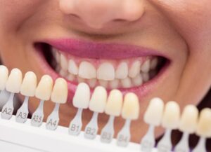 selecting colours for veneers