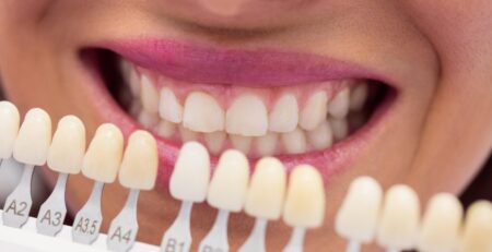 selecting colours for veneers