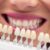 selecting colours for veneers