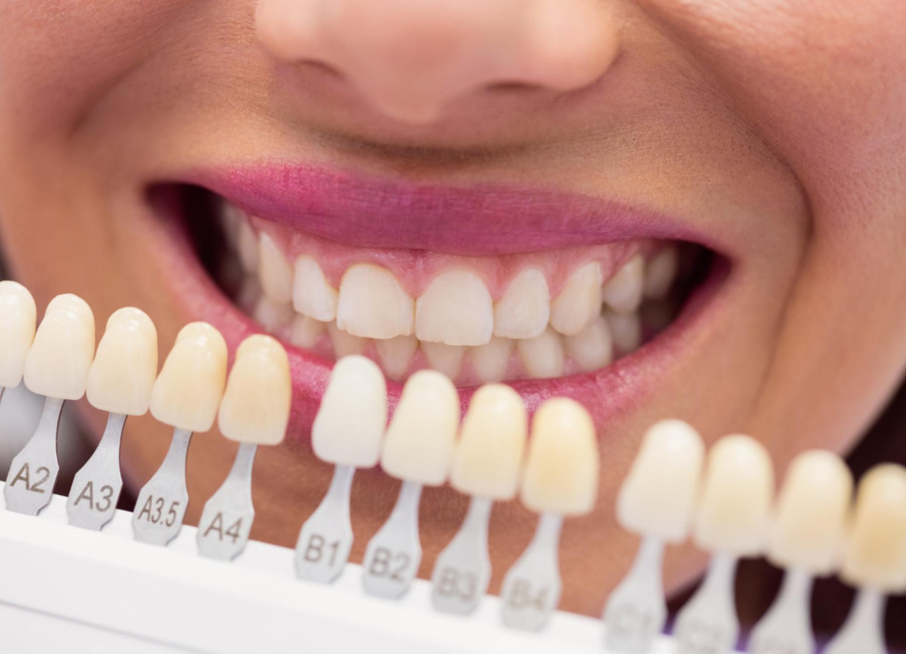 selecting colours for veneers