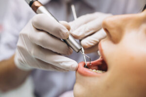 teeth clean at lumina dental