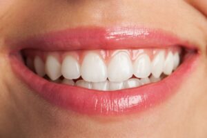 whitened teeth after teeth whitening