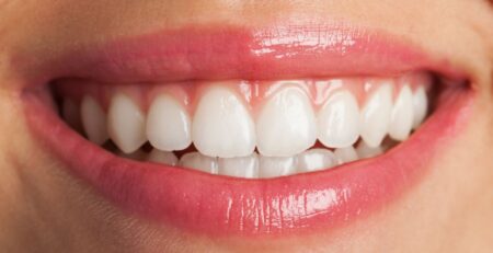 whitened teeth after teeth whitening