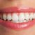 whitened teeth after teeth whitening
